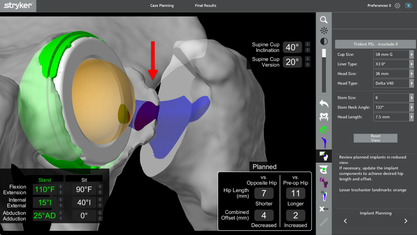 Robotik total kalça protezi ameliyatı Robotik total kalça protezi ameliyatı