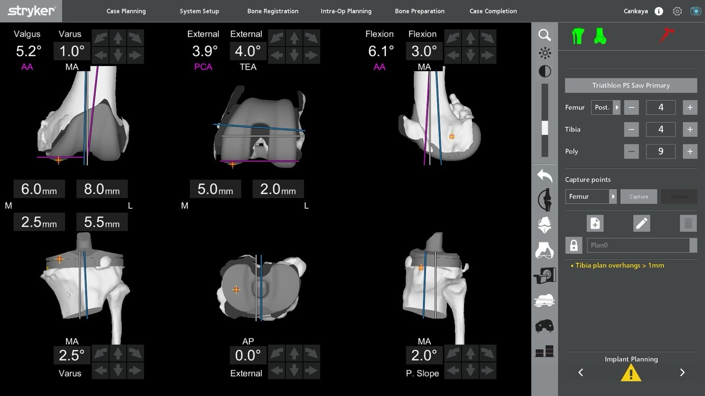 Figure 1 : Pre-operative planning involves the accurate determination of size, orientation and the alignment of your total knee replacement.  Figure 1 : Pre-operative planning involves the accurate determination of size, orientation and the alignment of your total knee replacement.