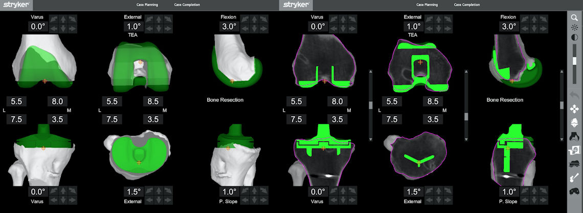 Figure 1 : Pre-operative planning is performed with 1 mm accuracy for robotic joint replacement.