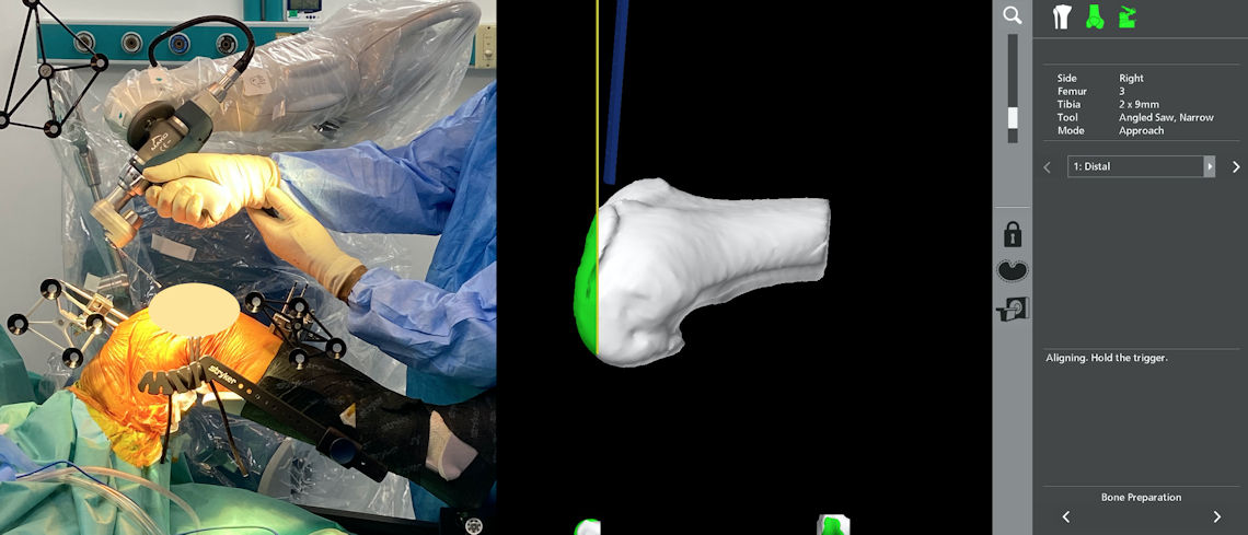 Figure 2 : Bone cuts performed with the help of the robotic arm are monitored on the screen.